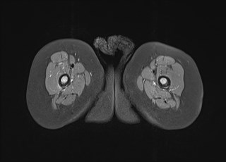 File:Neuroblastoma with bone metastases (Radiopaedia 67080-76414 Axial T1 C+ fat sat 34).jpg