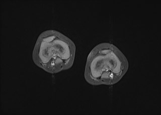 File:Neuroblastoma with bone metastases (Radiopaedia 67080-76414 Axial T1 C+ fat sat 7).jpg