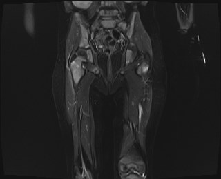 File:Neuroblastoma with bone metastases (Radiopaedia 67080-76414 Coronal STIR 15).jpg