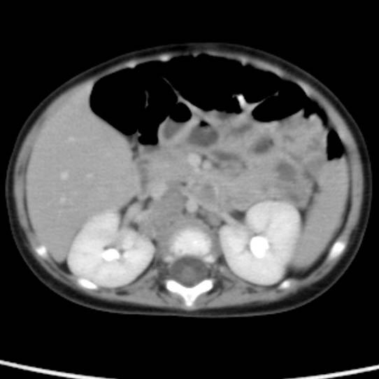 Neuroblastoma with skull metastases (Radiopaedia 30326-30960 C 24).jpg