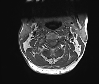 File:Neurofibromatosis type 1 (Radiopaedia 80355-93740 Axial T1 9).jpg