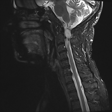 File:Neurofibromatosis type 1 (Radiopaedia 80355-93740 Sagittal STIR 4).jpg