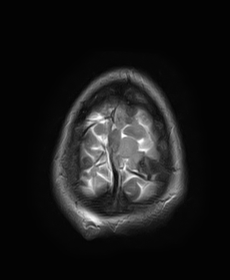 File:Neurofibromatosis type 2 (Radiopaedia 66211-75401 Axial T2 26).jpg