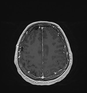 Neurofibromatosis type 2 (Radiopaedia 79097-92049 Axial T1 C+ 154).jpg