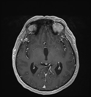 Neurofibromatosis type 2 (Radiopaedia 79097-92049 Axial T1 C+ 97).jpg