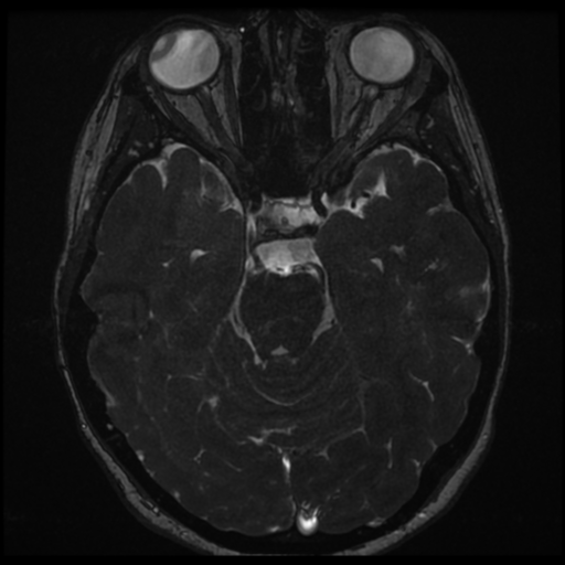 File:Neurofibromatosis type 2 - bilateral acoustic neuromata (Radiopaedia 40060-42566 Axial FIESTA 73).png