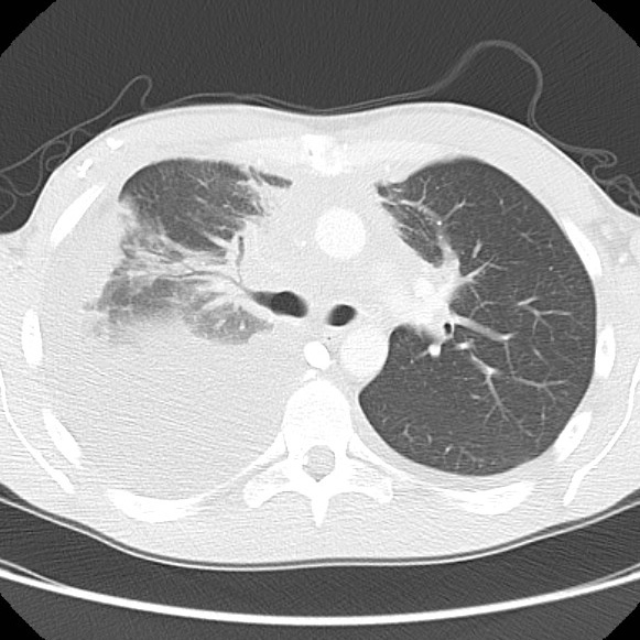 File:Non-Hodgkin lymphoma involving lung (Radiopaedia 29094-29470 Axial lung window 28).jpg