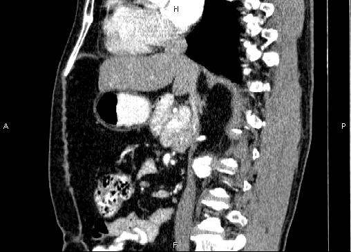 Non-syndromic pancreatic endocrine tumor (Radiopaedia 86958-103178 E 48).jpg