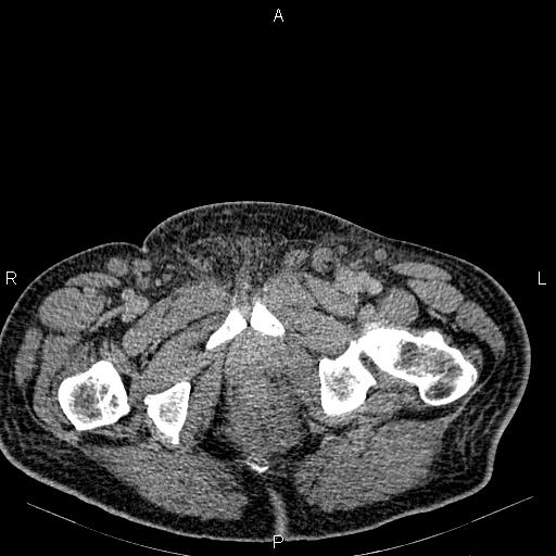 Non Hodgkin lymphoma in a patient with ankylosing spondylitis (Radiopaedia 84323-99621 Axial C+ delayed 87).jpg