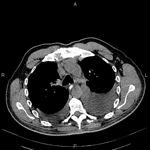 File:Non Hodgkin lymphoma in a patient with ankylosing spondylitis (Radiopaedia 84323-99621 Axial non-contrast 10).jpg
