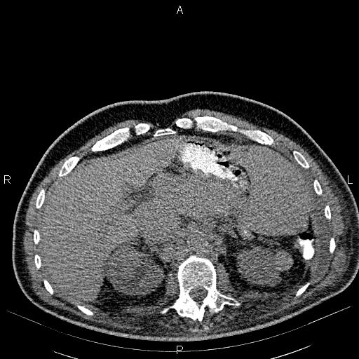File:Non Hodgkin lymphoma in a patient with ankylosing spondylitis (Radiopaedia 84323-99621 Axial non-contrast 30).jpg
