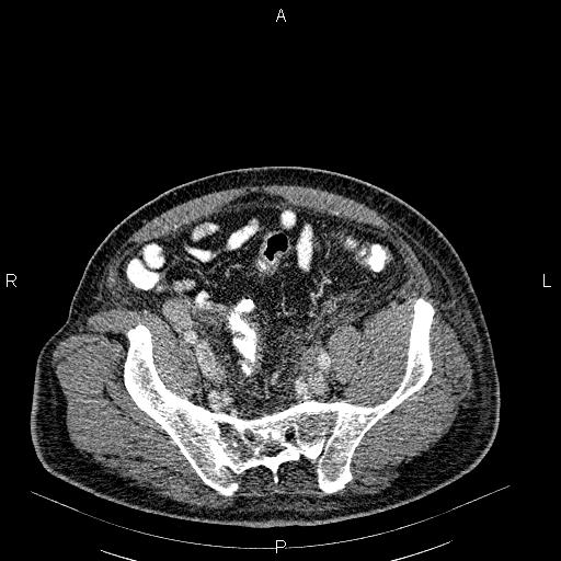 File:Non Hodgkin lymphoma in a patient with ankylosing spondylitis (Radiopaedia 84323-99621 B 54).jpg