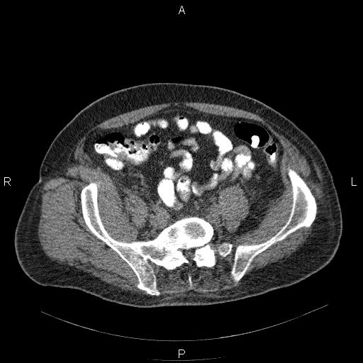 File:Non Hodgkin lymphoma in a patient with ankylosing spondylitis (Radiopaedia 84323-99624 Axial non-contrast 53).jpg