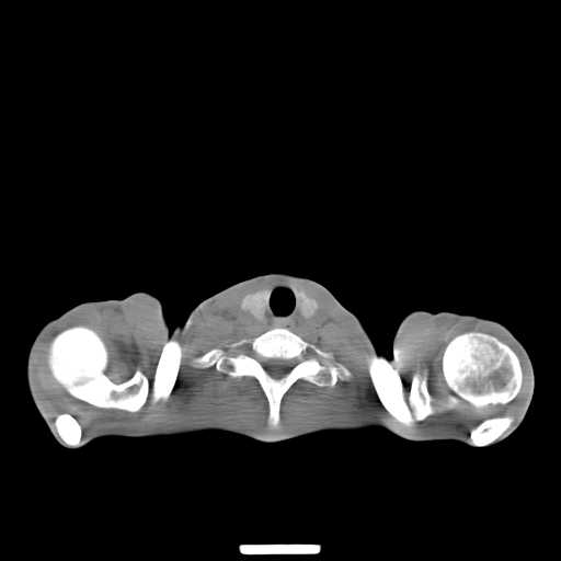 File:Non hodgkin lymphoma of the mediastinum (Radiopaedia 20814-20729 Axial non-contrast 1).jpg