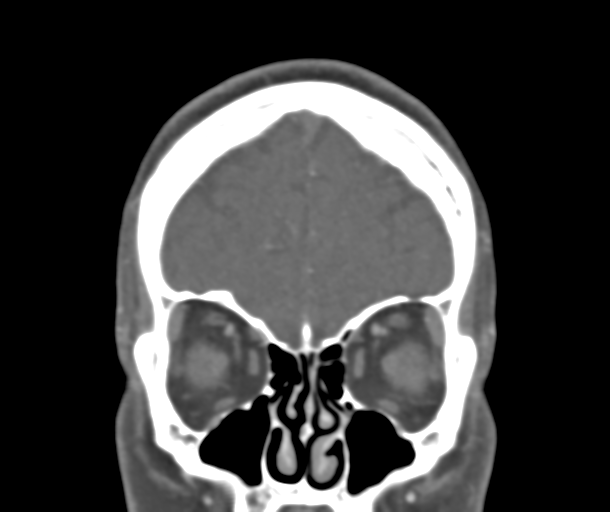 File:Normal CTA head (Radiopaedia 40801-43464 B 21).png