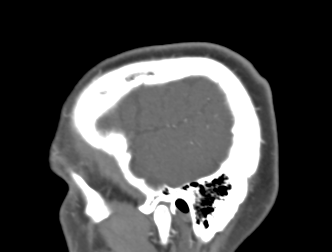 File:Normal CTA head (Radiopaedia 40801-43464 C 12).png
