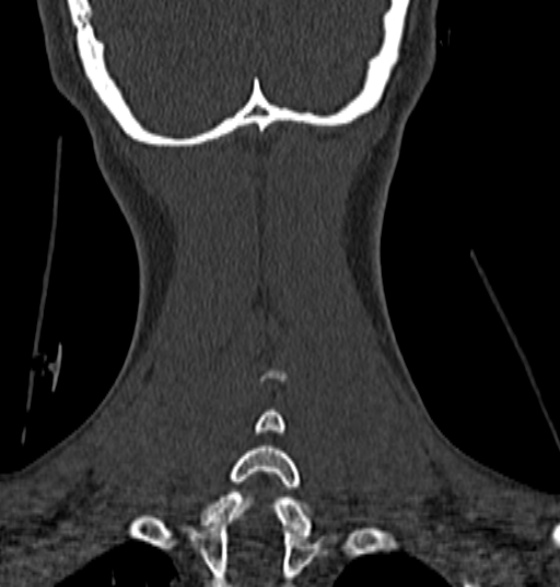 File:Normal CT cervical spine - 12-year-old (Radiopaedia 55352-61775 Coronal bone window 200).jpg