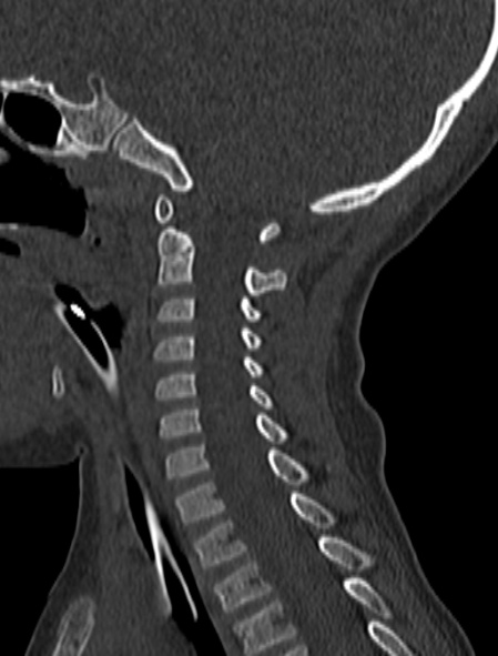 Normal CT cervical spine - pediatric (Radiopaedia 52549-58462 Sagittal bone window 87).jpg