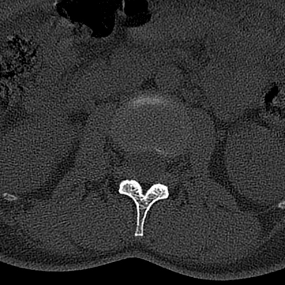 File:Normal CT lumbar spine (Radiopaedia 53981-60118 Axial bone window 28).jpg