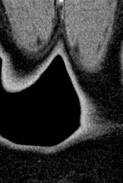 Normal CT lumbar spine (Radiopaedia 53981-60118 F 115).jpg