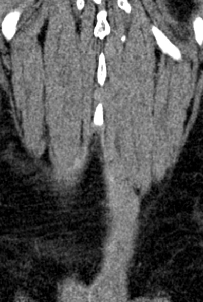 Normal CT lumbar spine (Radiopaedia 53981-60118 F 97).jpg