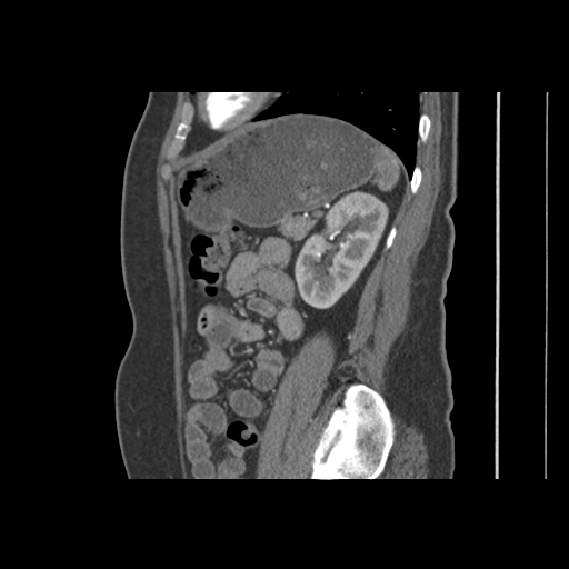 File:Normal CT renal artery angiogram (Radiopaedia 38727-40889 B 1).png