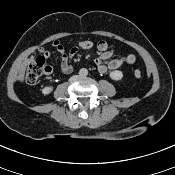 File:Normal CT split bolus study of the renal tract (Radiopaedia 48631-53634 Axial split bolus 156).jpg