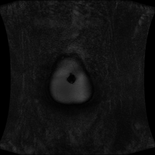 Normal MRI abdomen in pregnancy (Radiopaedia 88001-104541 N 10).jpg