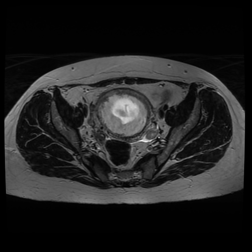 Normal MRI abdomen in pregnancy (Radiopaedia 88005-104548 Axial T2 28).jpg