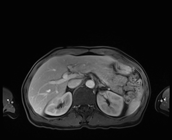 Normal adrenal glands MRI (Radiopaedia 82017-96004 K 28).jpg