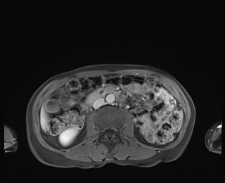 Normal adrenal glands MRI (Radiopaedia 82017-96004 M 51).jpg