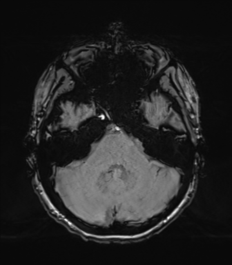 Normal brain MRI (TLE protocol) (Radiopaedia 40748-43405 Axial SWI 22).png