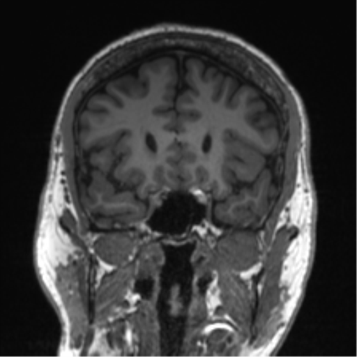 Normal brain MRI (non-focal epilepsy protocol) (Radiopaedia 53917-60040 Coronal T1 46).png