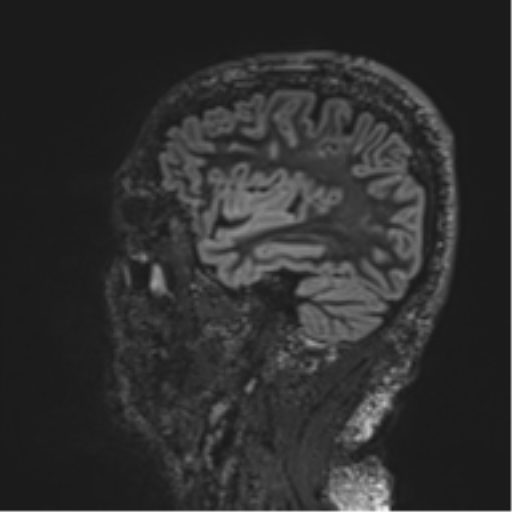 Normal brain MRI (non-focal epilepsy protocol) (Radiopaedia 53917-60040 Sagittal DIR 47).png