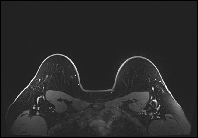 Normal breast MRI - dense breasts (Radiopaedia 80454-93850 C 198).jpg