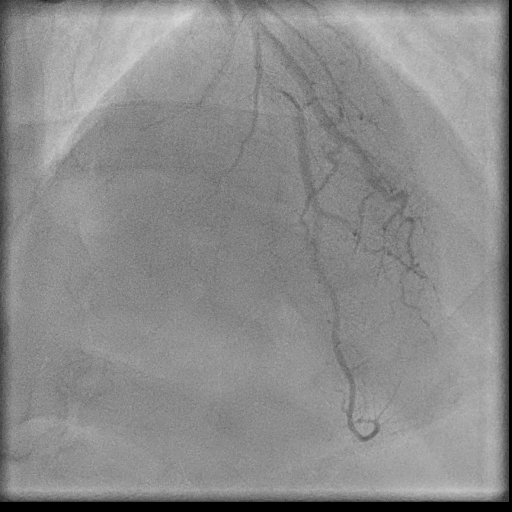 Normal coronary angiogram (DSA) (Radiopaedia 63081-71571 E 77).jpg