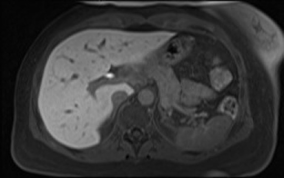 File:Normal hepatobiliary phase liver MRI (Radiopaedia 58968-66230 A 38).jpg