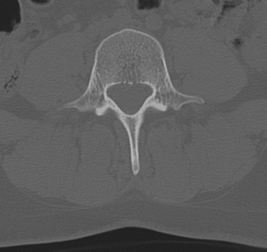 File:Normal lumbar spine CT (Radiopaedia 46533-50986 Axial bone window 47).png