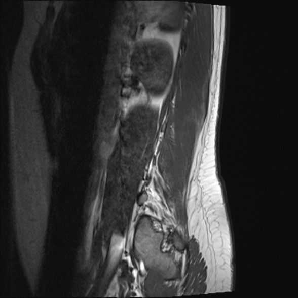 File:Normal lumbar spine MRI- 3 T (Radiopaedia 53280-59250 Sagittal T1 23).jpg