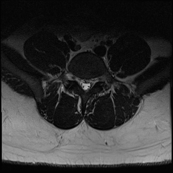 File:Normal lumbar spine MRI (Radiopaedia 47857-52609 Axial T2 24).jpg