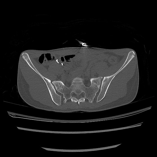 Normal pelvis CT (Radiopaedia 51471-57236 Axial bone window 32).jpg