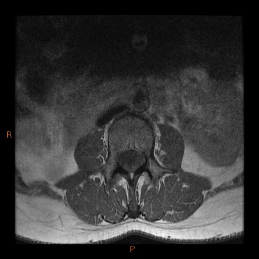 File:Normal spine MRI (Radiopaedia 77323-89408 Axial T1 3).jpg