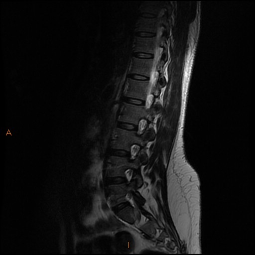 File:Normal spine MRI (Radiopaedia 77323-89408 Sagittal T2 5).jpg