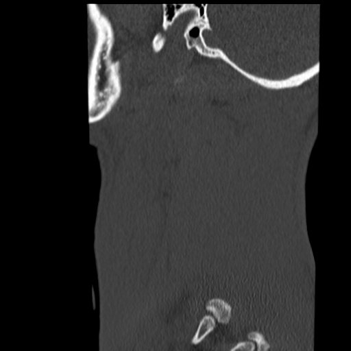 File:Normal trauma cervical spine (Radiopaedia 41017-43760 Sagittal bone window 48).png