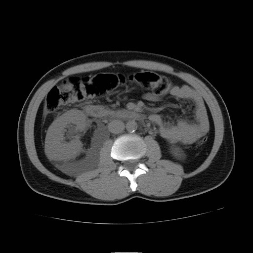 File:Obstructed kidney with perinephric urinoma (Radiopaedia 26889-27066 Axial non-contrast 25).jpg