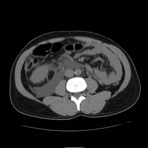 File:Obstructed kidney with perinephric urinoma (Radiopaedia 26889-27066 Axial non-contrast 31).jpg