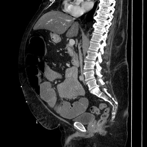 Obstructive colonic diverticular stricture (Radiopaedia 81085-94675 C 119).jpg
