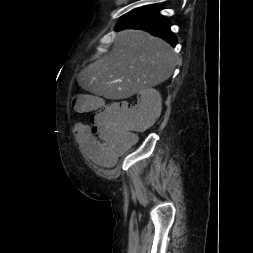 Obstructive colonic diverticular stricture (Radiopaedia 81085-94675 C 55).jpg