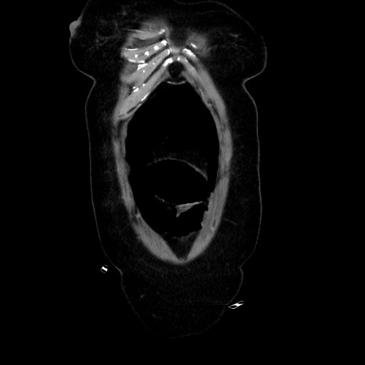 Obstructive distal colonic adenocarcinoma causing cecal perforation (Radiopaedia 86830-102989 C 43).jpg