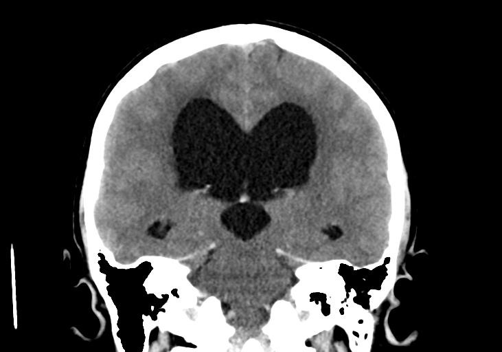 File:Obstructive hydrocephalus (Radiopaedia 30453-31119 Coronal non-contrast 23).jpg